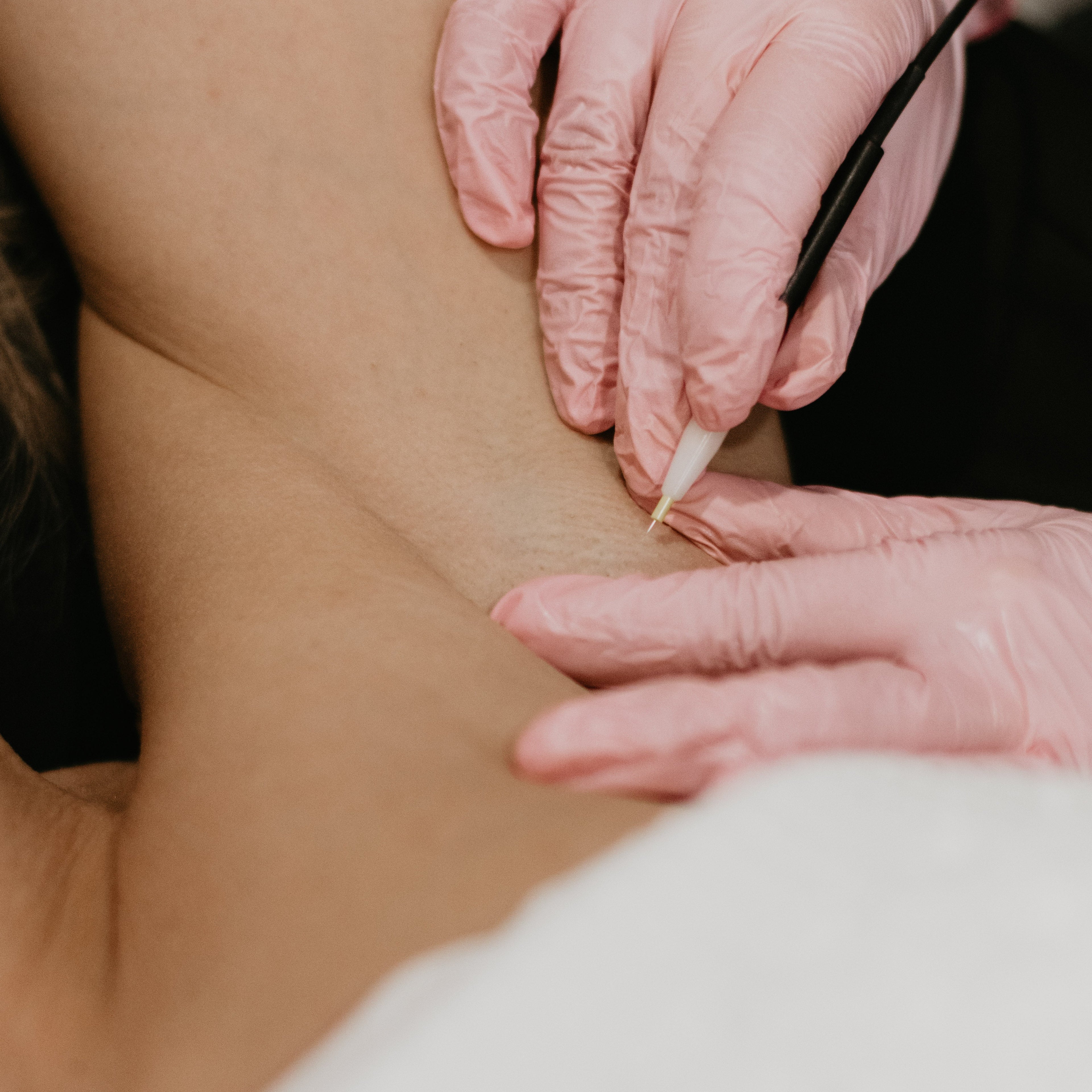 Électrolyse – Épilation progressive et précise