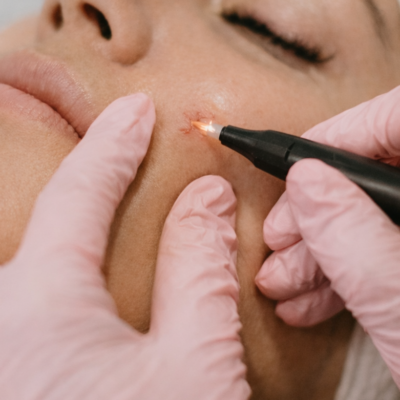 Thermocoagulation – Vasculaire et non vasculaire